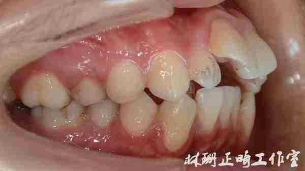 福州牙齿矫正 | 前突龅牙患者害怕骨钉,改用z钩获得很好的内收效果