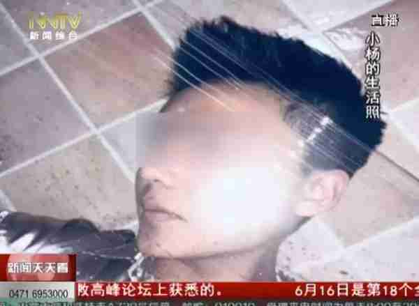 「天天看•热线」术后特别疼!19岁学生花7千多隆鼻,医生竟然说后果很严重