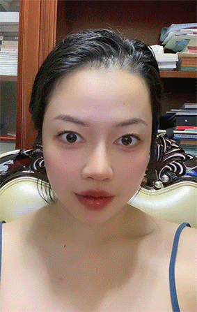 做完膨体鼻最害怕的事:感染与取出!整形医生谈膨体隆鼻的后遗症