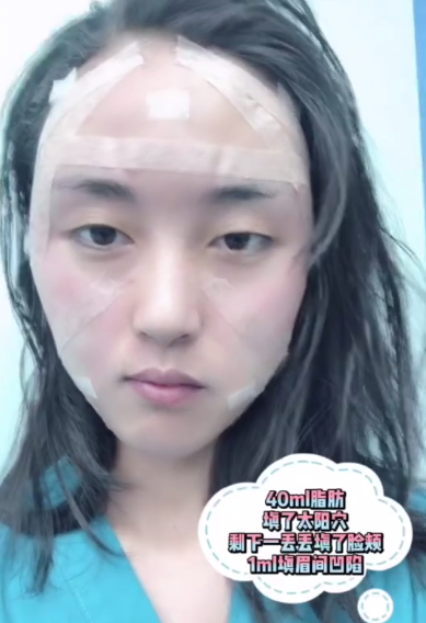 自体脂肪填充全脸后为什么会面部僵硬?填充失败了吗?听听医生说