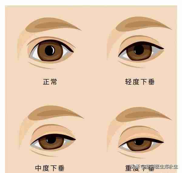 同样是割双眼皮,为什么有的人年轻了10岁,而有的人老了10岁?