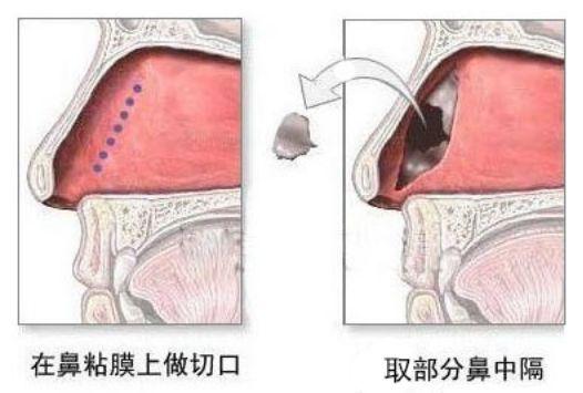 注射隆鼻、线雕隆鼻、假体隆鼻、自体肋骨隆鼻,哪个适合你?