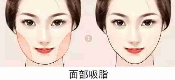 脸大胖十斤!面部吸脂瘦脸真的不会反弹吗?