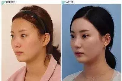 玻尿酸隆鼻VS线雕隆鼻