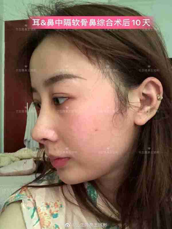 醒醒吧!L型假体隆鼻+耳软骨垫鼻尖,还在骗你是鼻综合