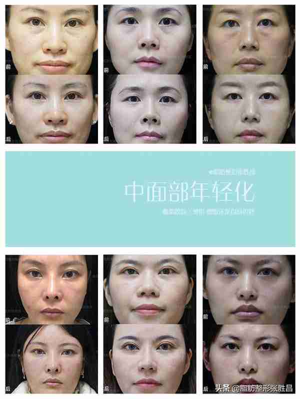 我来揭开“脂肪填充”的5个真相，想做这手术的人可以来看看