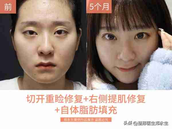 同样是割双眼皮,为什么有的人年轻了10岁,而有的人老了10岁?