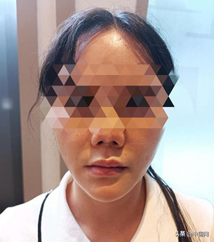 女子整形感染后变“朝天鼻”,此前曾做过5次手术
