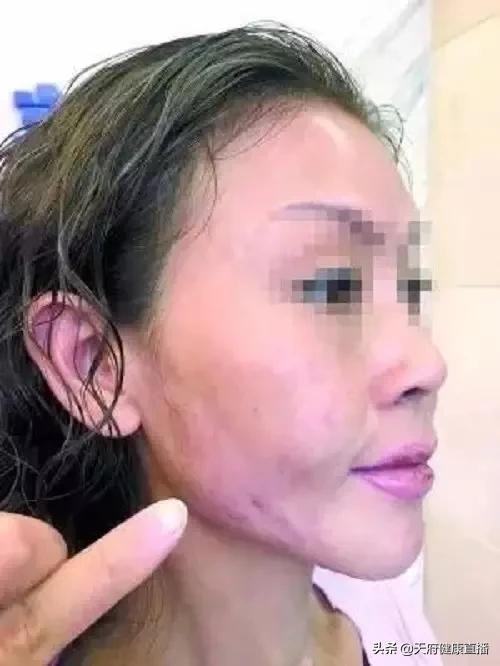 吸脂会让皮肤松垮?脂肪填充会移位?来听听八大处医生怎么说