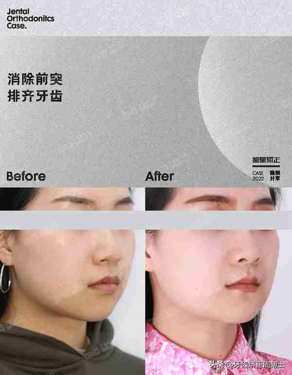 缺牙先别急着种!高性价比矫正案例,一次省去2颗种植费用