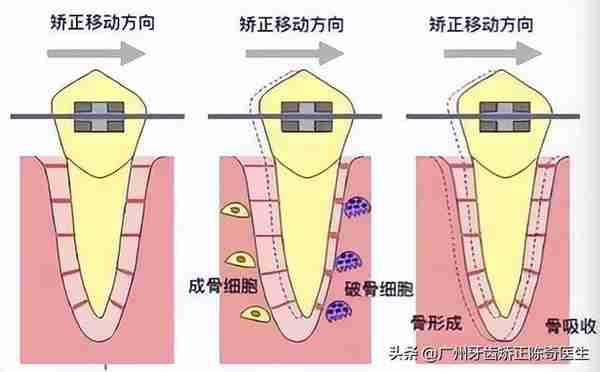 牙齿矫正的7大误区!别让这些耽误了矫正好时机