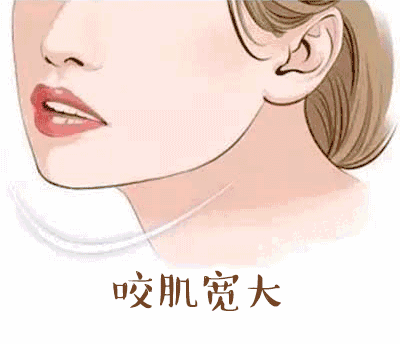 我打瘦脸针“差不多有10年”了,分享真实经验