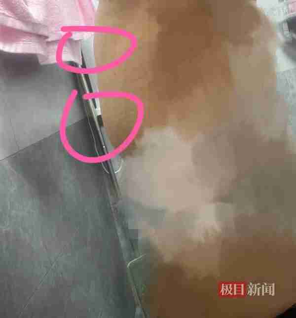 极目3·15|女子花2.4万元做吸脂手术,手臂和腰部变得凹凸不平