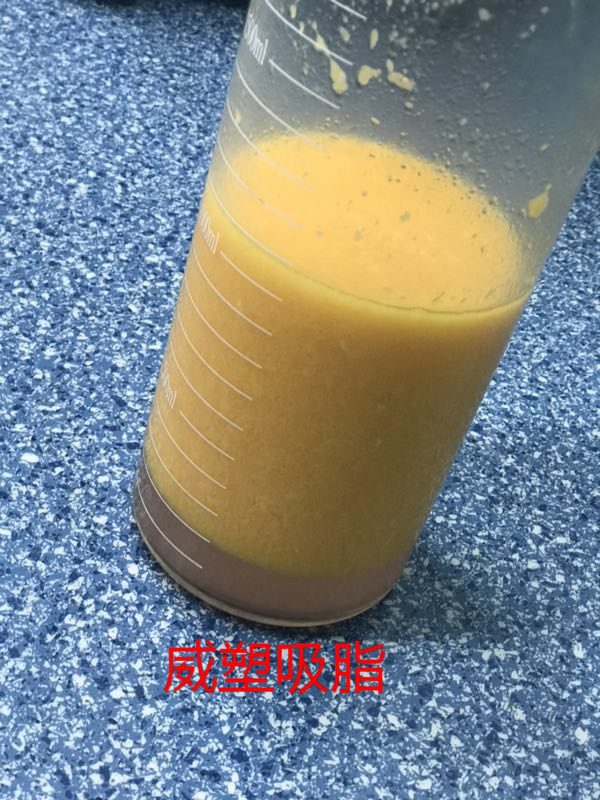 吸脂该如何选择?威塑吸脂有什么危害吗