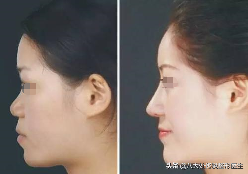 面部一枝花,全靠鼻当家,“一支玻尿酸”解救娱乐圈无数塌鼻梁