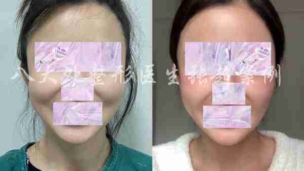 八大处张超面部吸脂反馈合集(五)