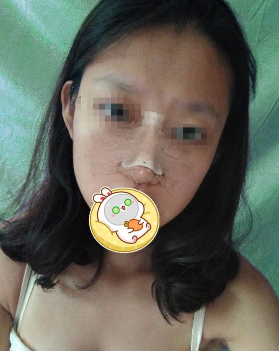 男朋友给20000叫我去隆鼻,我的鼻子真有那么难看吗