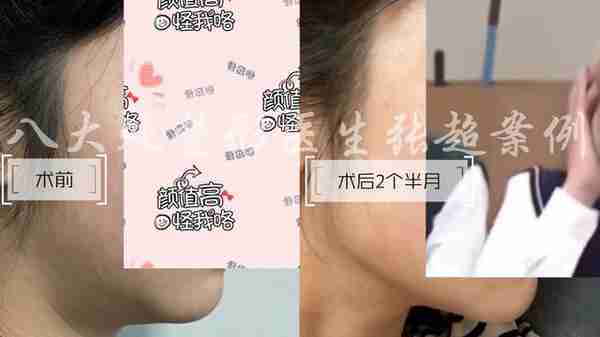 八大处张超面部吸脂反馈合集(五)