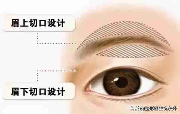 想做“提眉手术”的人,听医生讲讲这25个真相