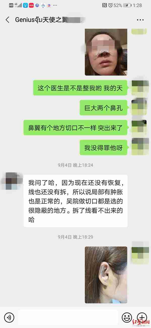 如此整形!取耳软骨做鼻头整形,鼻子好看了耳朵有个缺口 当事人:耳机都挂不住