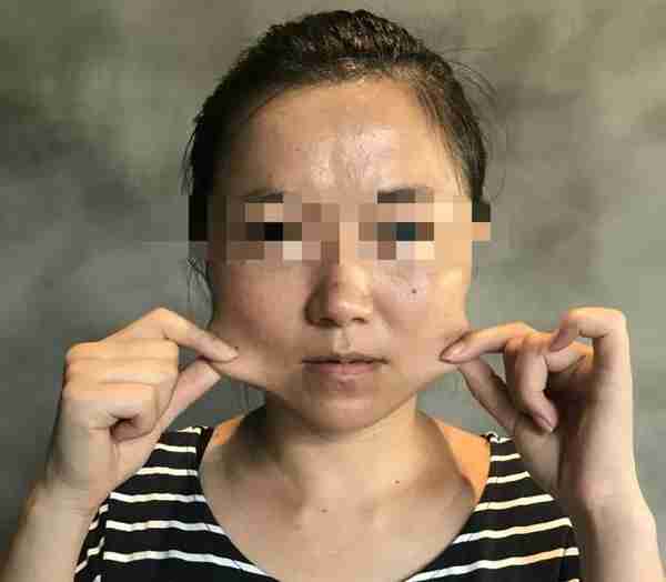 被瘦脸针“毁容”之后,索赔200万仅可得1万 法律保护健康但不保护美