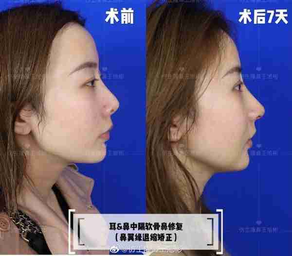 醒醒吧!L型假体隆鼻+耳软骨垫鼻尖,还在骗你是鼻综合