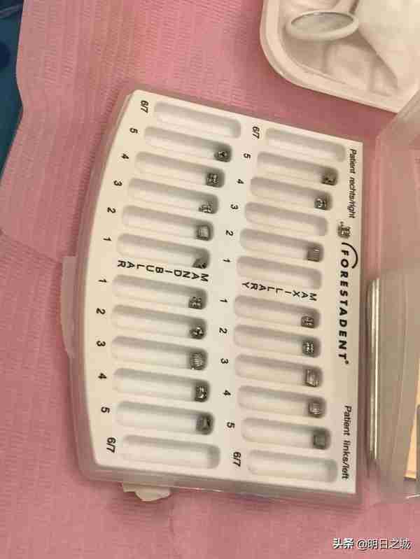 长春15岁女生矫正牙齿拔4颗牙,2个月花近3万终于戴上了牙套