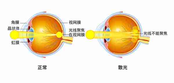 30个孩子6个散光!为什么现在散光的孩子特别多?能彻底治愈吗?