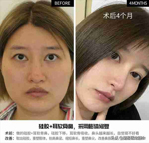 关于玻尿酸隆鼻、填充太阳穴、泪沟,那些医生不会告诉你的