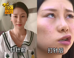 一针下去,浙江姑娘嘴巴歪斜,更惨的是……
