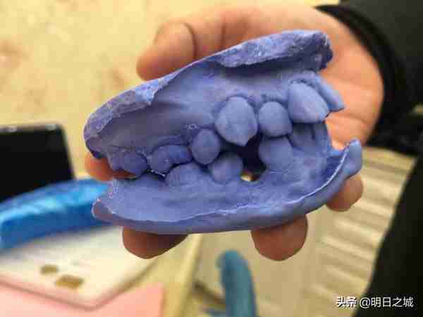 长春15岁女生矫正牙齿拔4颗牙,2个月花近3万终于戴上了牙套