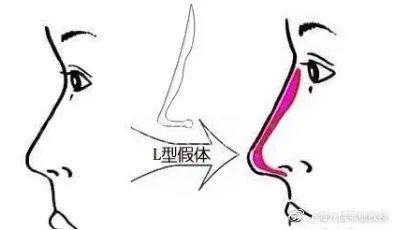 相比隆鼻,鼻综合其实更适合你