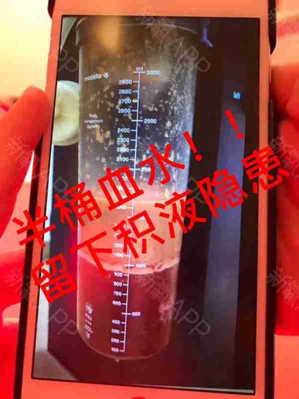 吸脂术后有积液是啥原因?