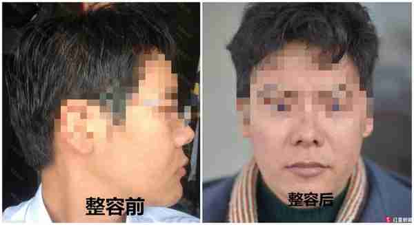男子花1.2万隆鼻后竟能晃动 美容院:属正常误差范围内