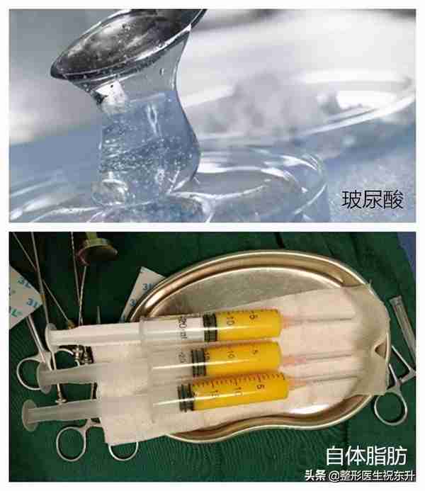 填充苹果肌,选“玻尿酸”好还是“自体脂肪”好?