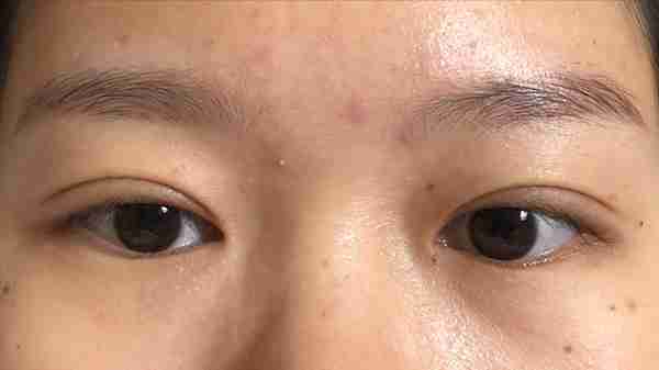 做个双眼皮要花1.5w元钱?为什么别人几百块就行?医生告诉您