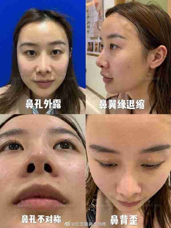 醒醒吧!L型假体隆鼻+耳软骨垫鼻尖,还在骗你是鼻综合