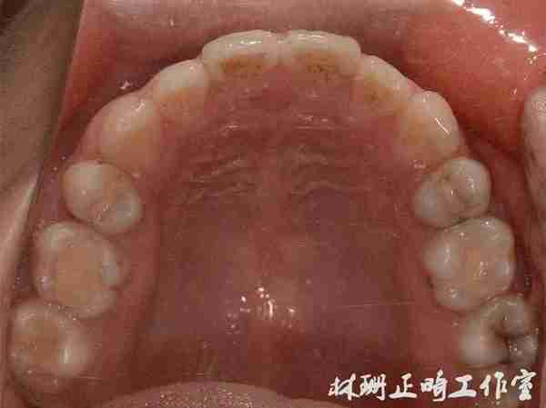 福州牙齿矫正 | 前突龅牙患者害怕骨钉,改用z钩获得很好的内收效果