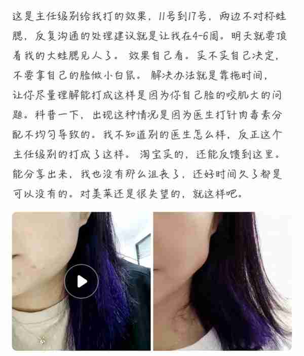 女子打瘦脸针后右脸咬肌凸出疑似“蛙腮”,深圳美莱回应