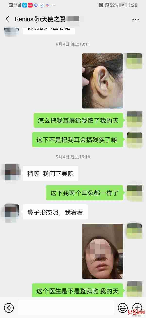 如此整形!取耳软骨做鼻头整形,鼻子好看了耳朵有个缺口 当事人:耳机都挂不住