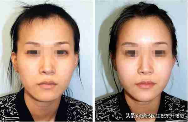 面部做了自体脂肪填充会怎样?一张脸美得像“长开了”般自然