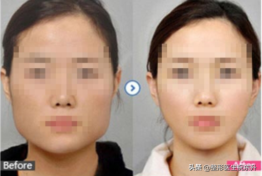 想瘦脸又担心打瘦脸针不安全,有没有其他办法?知道的聊一聊