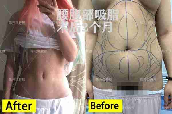 想全身吸脂怎么办?看完这篇你就知道专业吸脂医生是怎样规划的了