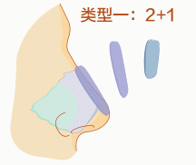 网上大热的肋骨鼻到底怎么样?取肋软骨会对身体有影响吗?