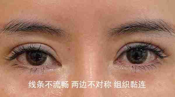 做双眼皮要花多少钱?怎么判断要不要开眼角?有哪些注意事项?