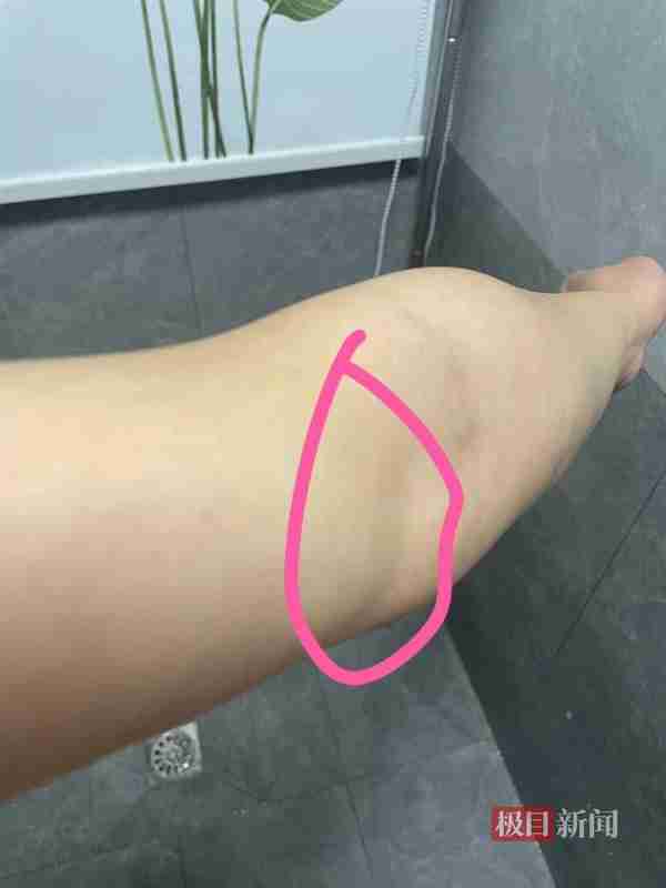 极目3·15|女子花2.4万元做吸脂手术,手臂和腰部变得凹凸不平