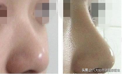 面部一枝花,全靠鼻当家,“一支玻尿酸”解救娱乐圈无数塌鼻梁