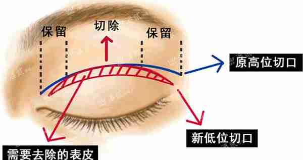 双眼皮眼头眼尾为什么会分叉?双眼皮修复时内外高位疤痕的处理?