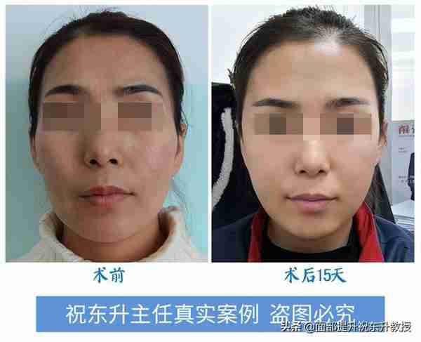 怎么做全脸脂肪填充不后悔?看了我的这一段经历就懂了