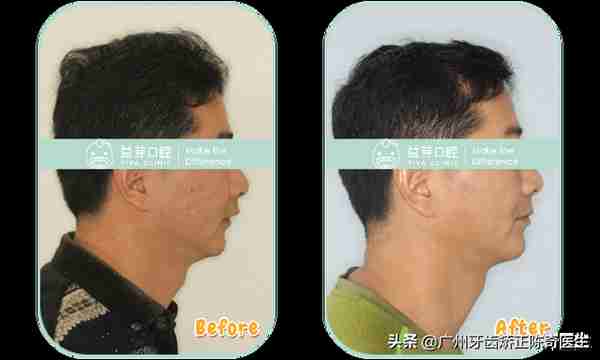 牙齿矫正的7大误区!别让这些耽误了矫正好时机